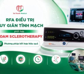 RFA kết hợp foam sclerotherapy: Giải pháp toàn diện trong điều trị suy giãn tĩnh mạch chi dưới