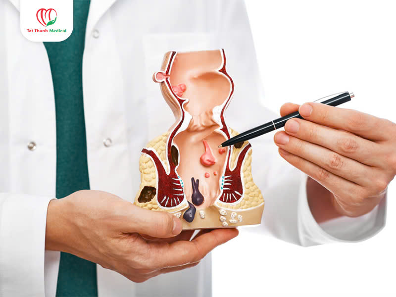 điều trị trĩ bằng sóng cao tần