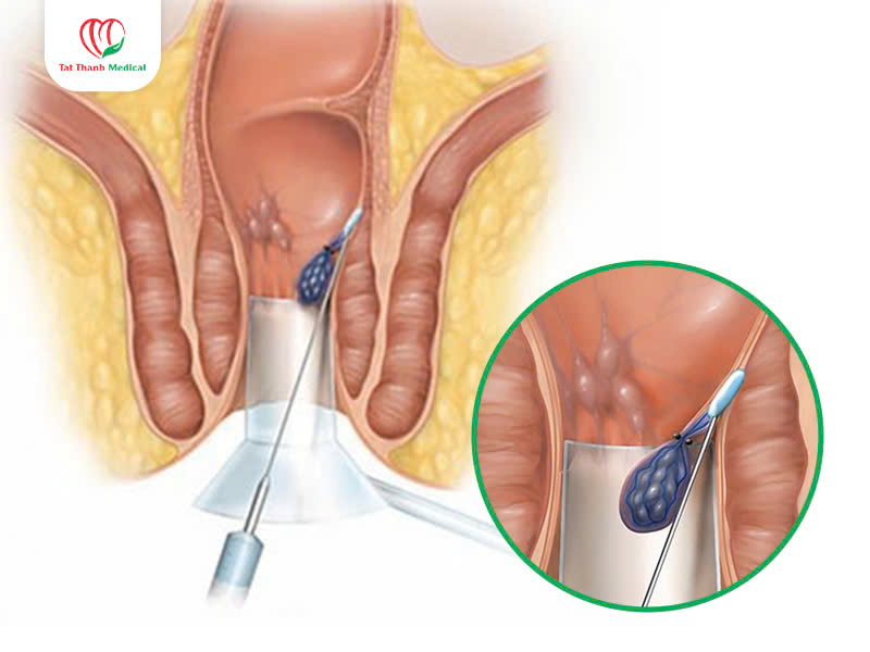 điều trị trĩ bằng sóng cao tần