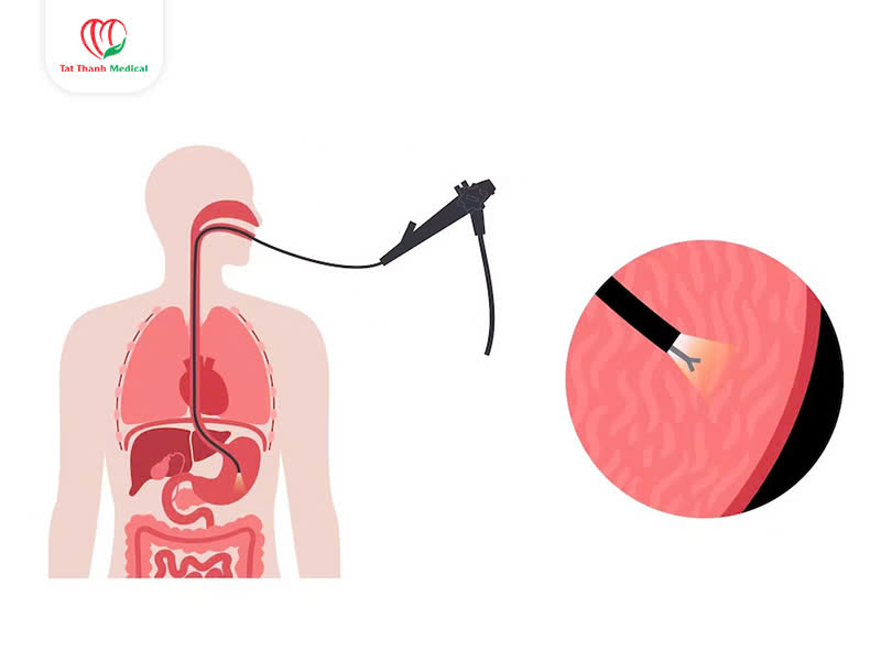 Hệ thống nội soi tiêu hóa dạ dày đại tràng: Đâu là lựa chọn hàng đầu?