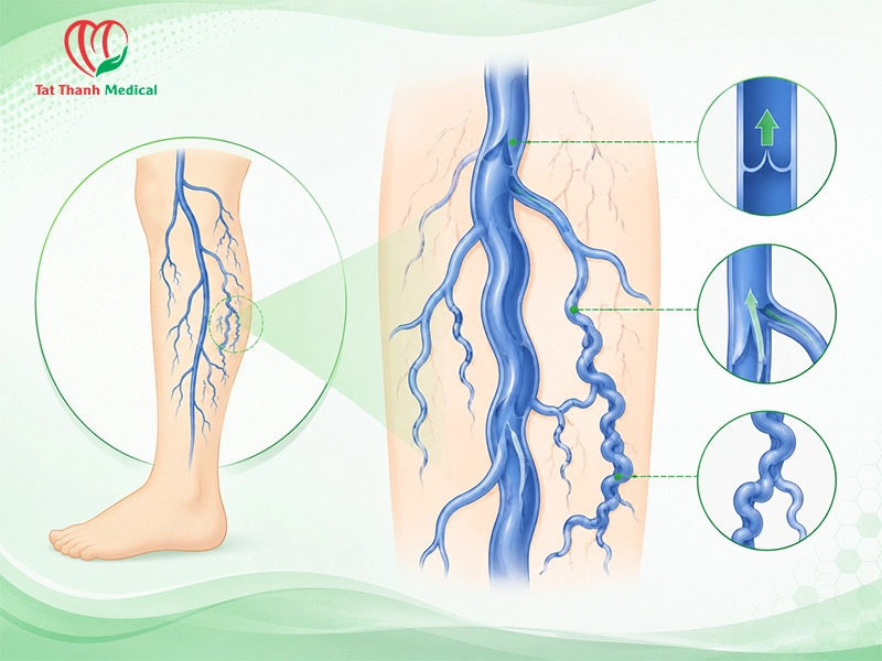 RFA kết hợp foam sclerotherapy: Giải pháp toàn diện trong điều trị suy giãn tĩnh mạch chi dưới
